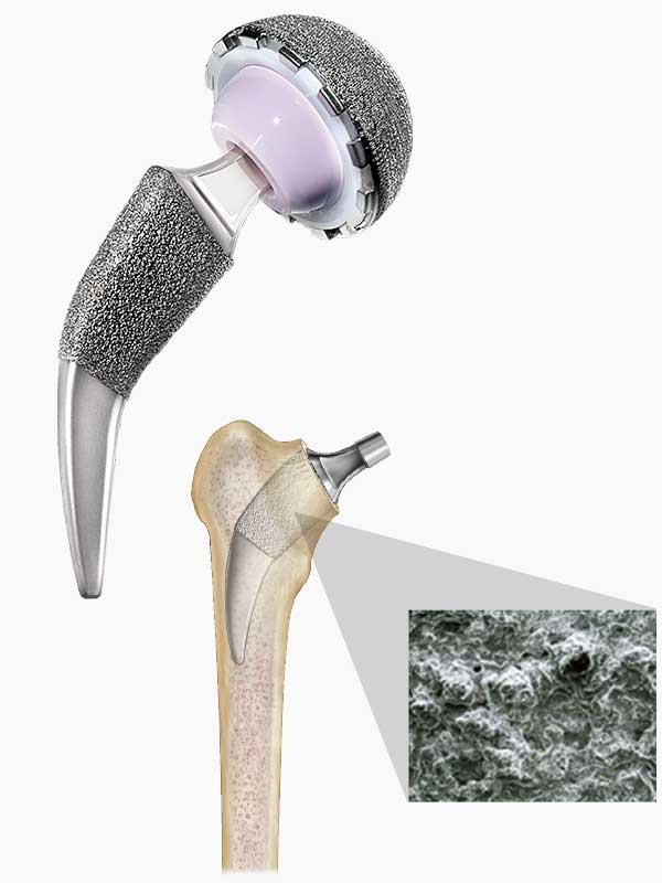 Alteon Neck Preserving Hip Stem. Developed for primary femoral solutions, the Alteon® Neck Preserving Femoral Hip Stem.