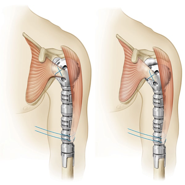 Exactech Equinoxe Shoulder Humeral Reconstruction Prosthesis. Soft tissue fixation options on all midsections and proximal bodies.