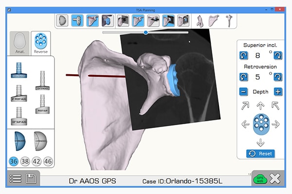 Exactech Equinoxe Shoulder Planning App. The CT-based Planning App software immediately reconstructs the scapula in 3D, enabling implant selection and placement prior to surgery.