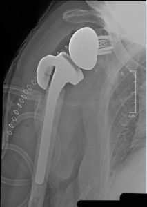 Post-surgery X-ray with the Equinoxe Humeral Augmented Tray. Photo courtesy: Howard Routman, DO