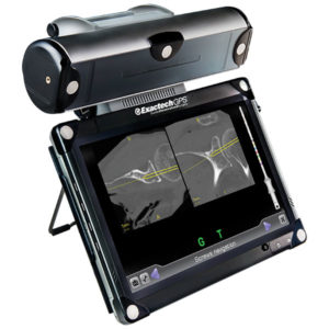 ExactechGPS Shoulder Replacement Technology. Exactech Active Intelligence surgeons use a computer-assisted surgical technology called ExactechGPS Guided Personalized Surgery
