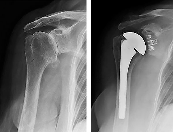 ExactechGPS Shoulder Application X-rays of a shoulder replacement surgery