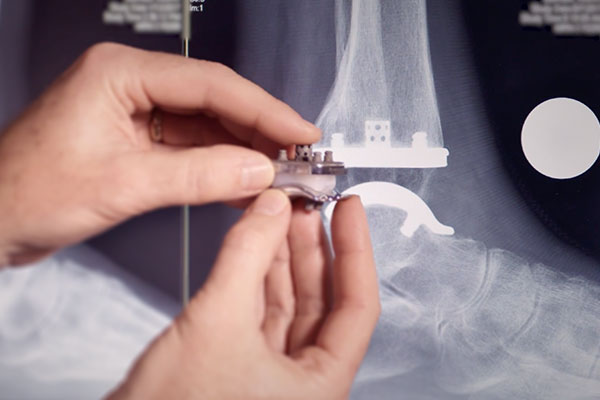 ankle replacement surgery