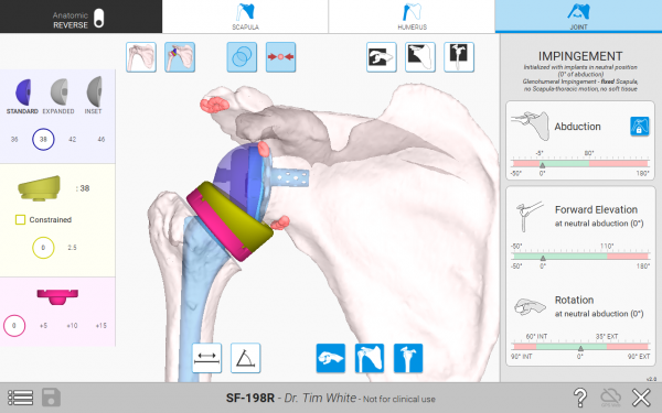 The Equinoxe Planning App (v.2.0) assists surgeons in assessing impingement and range of motion.