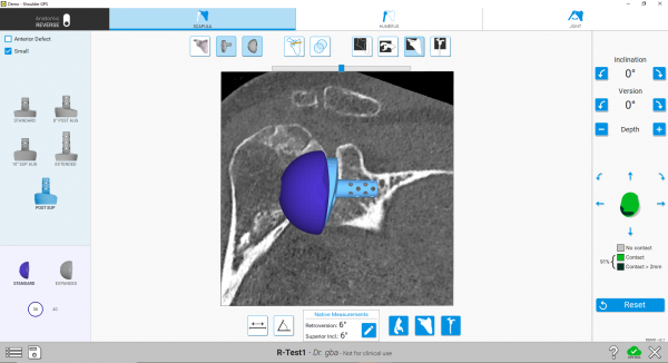 The Equinoxe Planning App (v. 2.0) continues to allow surgeons to plan the placement of glenoid components for aTSA and rTSA