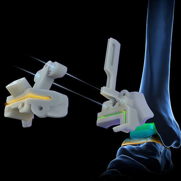 Exactech Ankle PSI