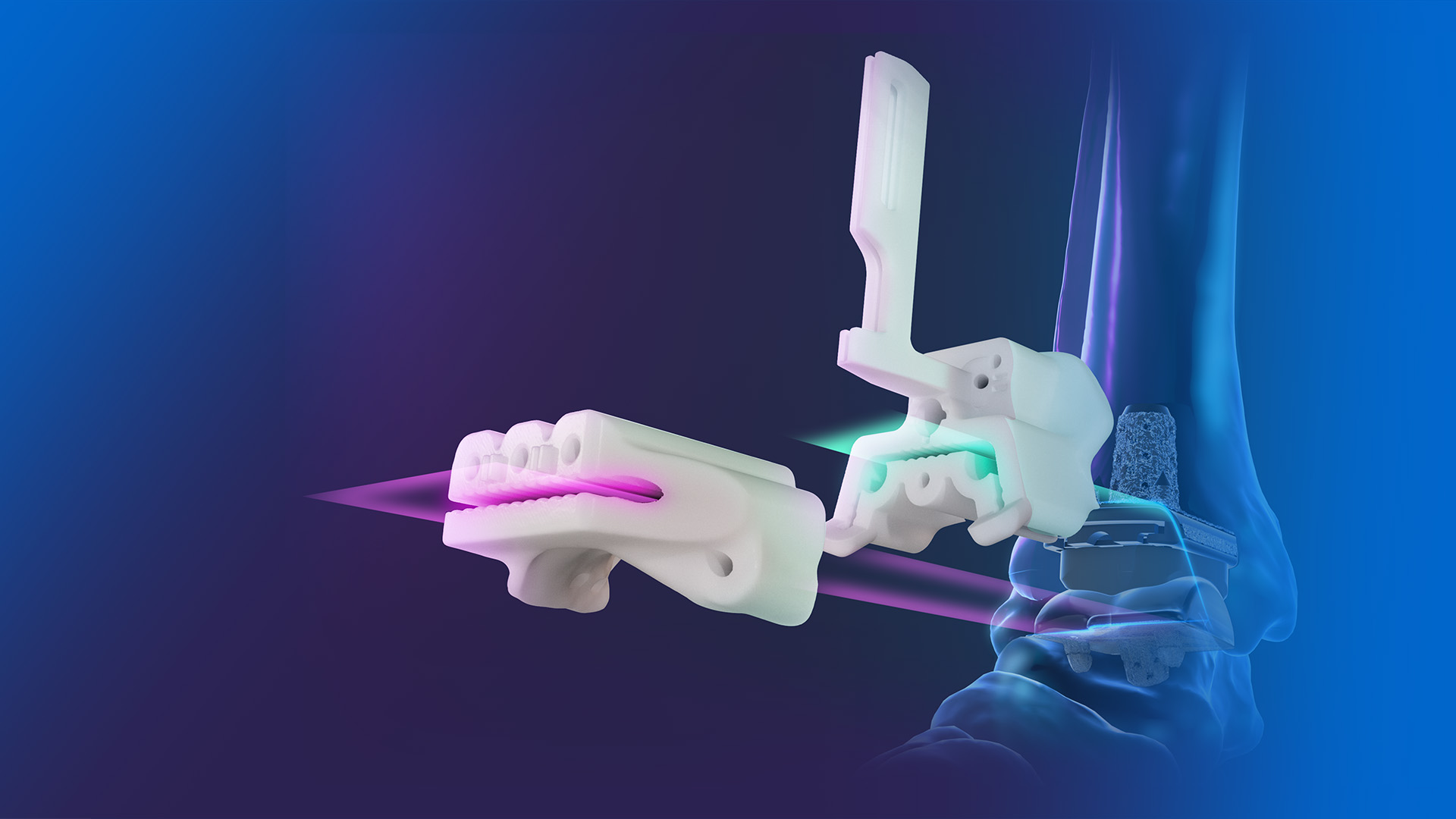 Exactech Vantage Ankle PSI