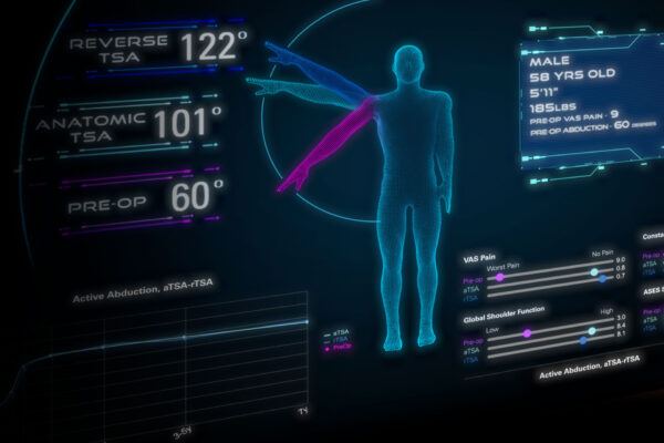 Exactech Active Intelligence® Smart Technology, Predict+® Patient-Specific Outcome Predictor