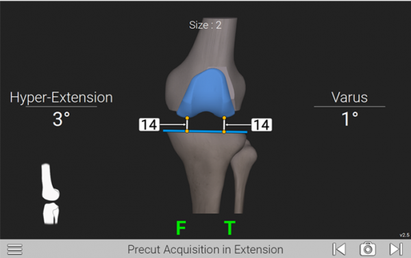 Exactech Knee Newton GPS Technology for TKA