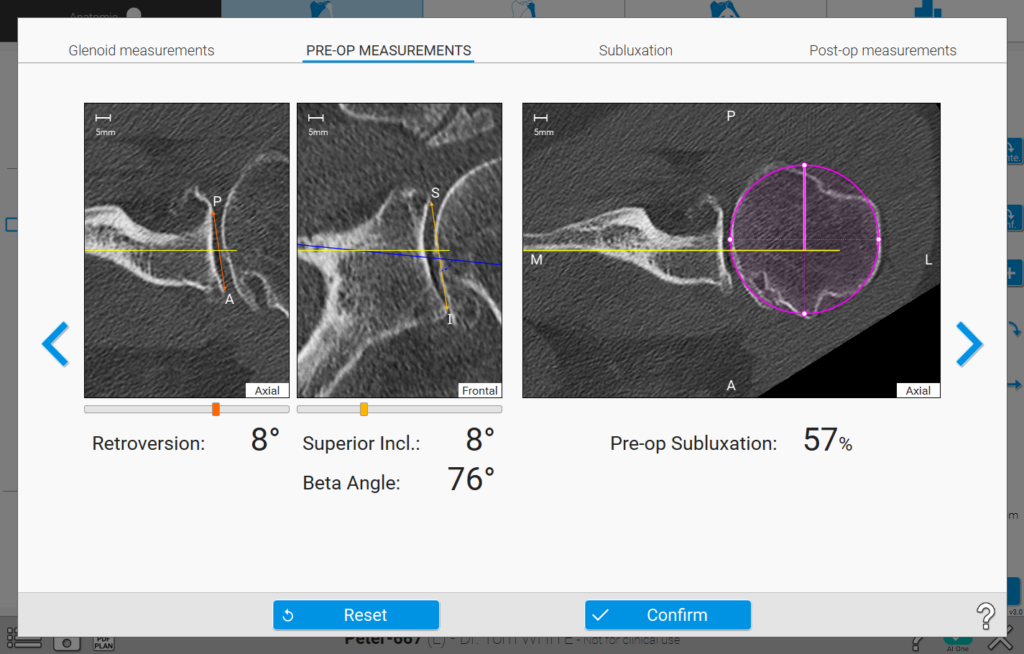 Shoulder Planning App pre-operative subluxation, beta angle measurements, and lateralization and lengthening measurements to optimize your implant selection Screen