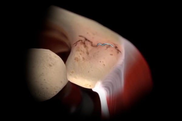 Review of Acromial and Scapular Fractures After Reverse Shoulder Arthroplasty: Inlay vs. Onlay Component Designs Illustration of Shoulder Fracture