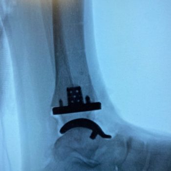 Exactech Ankle X-ray of the Vantage Ankle 3D+ implant from a lateral view.