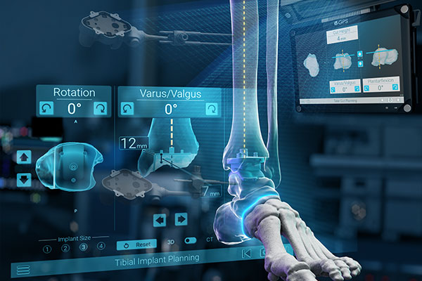 Exactech GPS Ankle with Active Intelligence