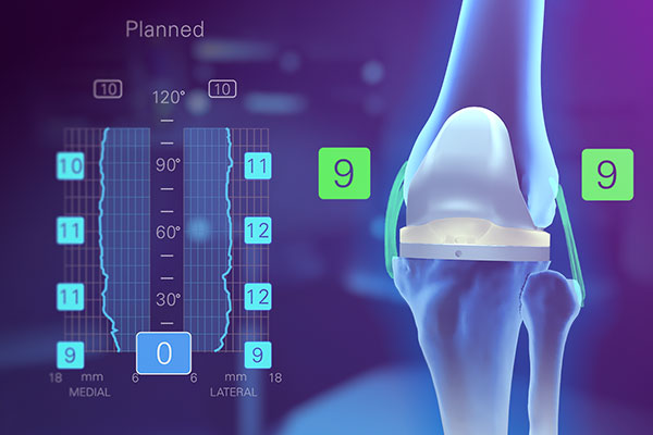 Exactech Newton Knee with Active Intelligence