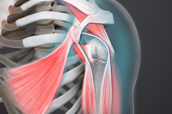 Pectoralis Minor Tenotomy in Shoulder Arthroplasty: A Novel Therapeutic Approach