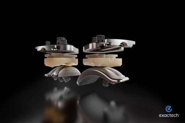 Exactech Vantage Ankle Surgeries with Advanced Activit-E Polyethylene