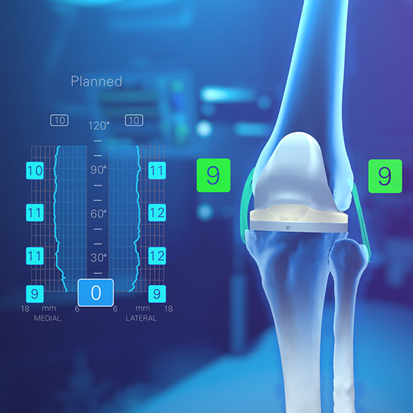 Exactech Newton Knee with GPS