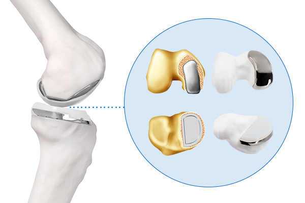 Exactech Truliant Reflex Uni Knee with Active Intelligence by BodyCad